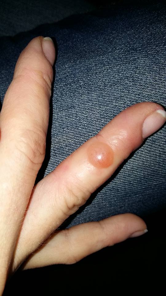 uczulenie na Semilac