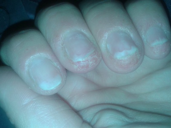 uczulenie na Semilac