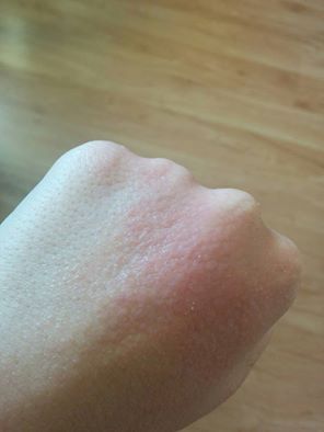 uczulenie na Semilac