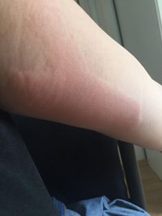 uczulenie na Semilac