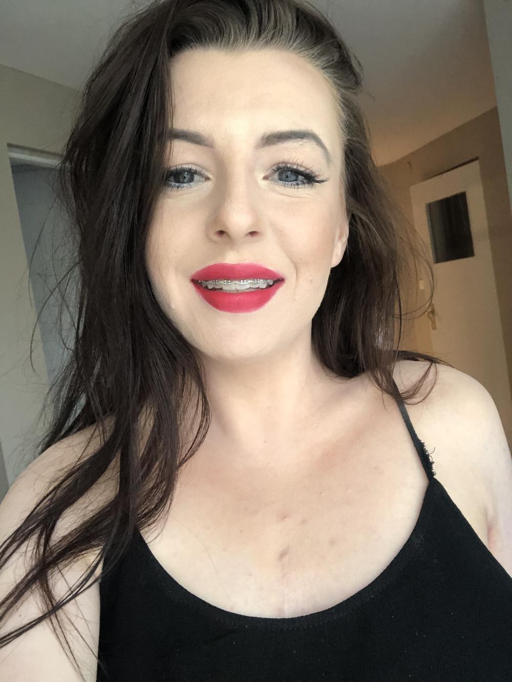 Aparat na zęby/ usunięcie zdrowych zębów - Wsparcie