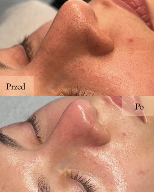 Jakie kosmetyki na niechciane zaskórniki - cera dojrzała