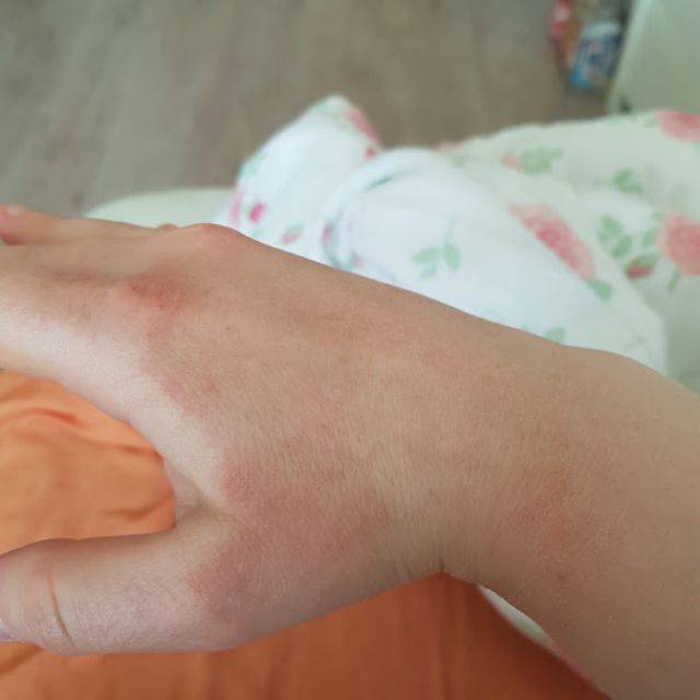 Sucha skóra dłoni - ratunku!